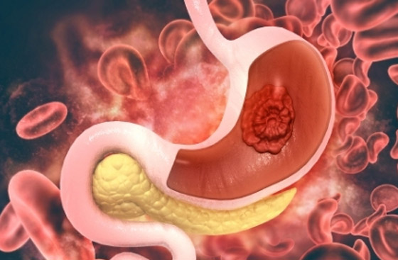 علامات غير شائعة لسرطان المعدة.. منها التعب الشديد صورة رقم 5