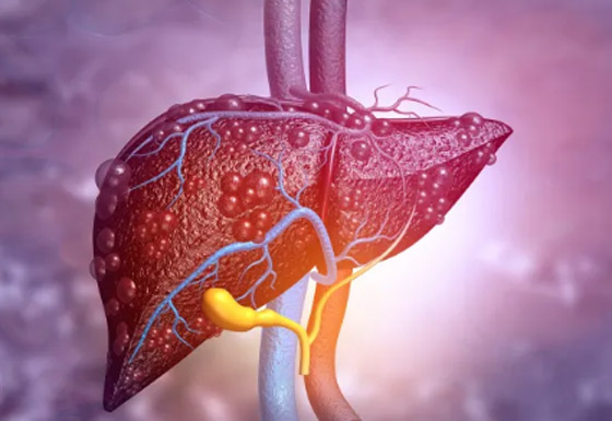 5 علامات تظهر فى الجسم عند الإصابة بعدوى فى الكبد صورة رقم 2
