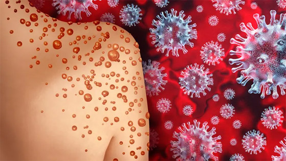 يثير مخاوف عالمية.. نيويورك تؤكد أول إصابة بجدري القردة صورة رقم 1