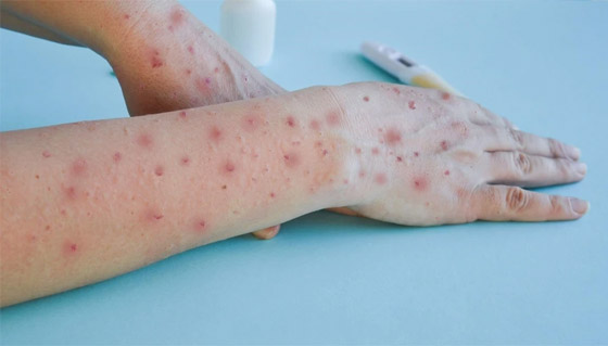 يثير مخاوف عالمية.. نيويورك تؤكد أول إصابة بجدري القردة صورة رقم 5