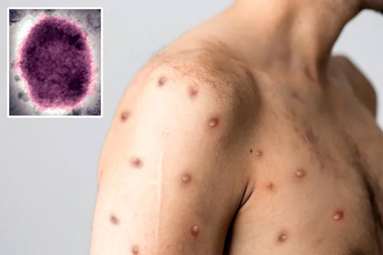 يثير مخاوف عالمية.. نيويورك تؤكد أول إصابة بجدري القردة صورة رقم 3