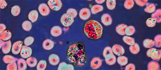 المرض الغامض يُرعب الأطباء.. يقتل ضحاياه بـ48 ساعة وهذه عوارضه صورة رقم 2 المرض الغامض يُرعب الأطباء.. يقتل ضحاياه بـ48 ساعة وهذه عوارضه صورة رقم 2