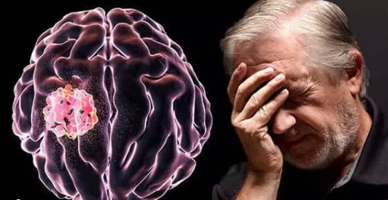 مش بس الصداع.. 4 علامات تحذيرية مبكرة لأورام المخ لا تتجاهلها صورة رقم 2