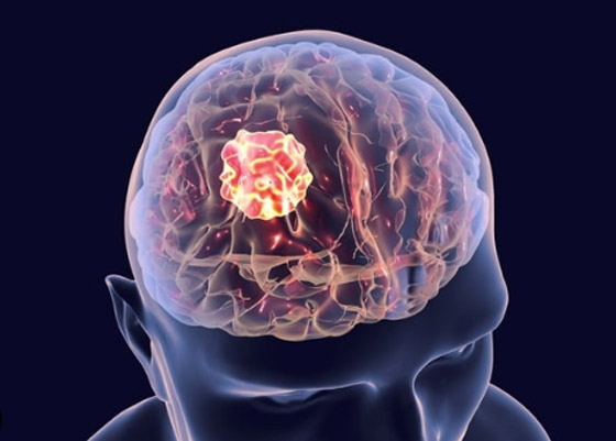 مش بس الصداع.. 4 علامات تحذيرية مبكرة لأورام المخ لا تتجاهلها صورة رقم 4