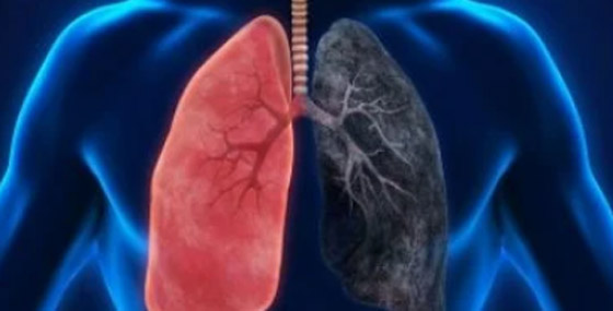 أعراض خفية لسرطان الرئة تظهر على الكتفين والرقبة صورة رقم 1