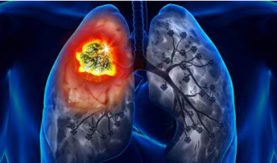 أعراض خفية لسرطان الرئة تظهر على الكتفين والرقبة صورة رقم 2