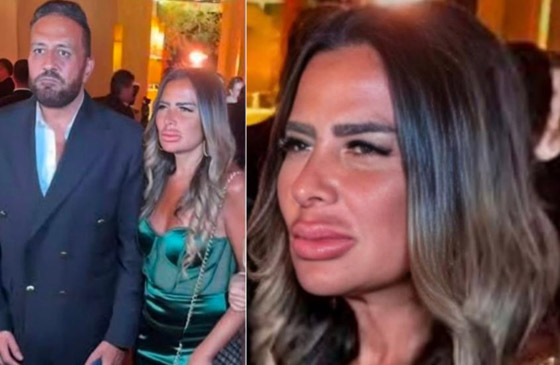 صورة رقم 2 - زوجة فنان مصري تشعل ضجة بسبب تشوه شفتيها بعد عملية حقن (فيلر) فاشلة! تبدو كأنها بـ شنب! صورة رقم 2 - زوجة فنان مصري تشعل ضجة بسبب تشوه شفتيها بعد عملية حقن (فيلر) فاشلة! تبدو كأنها بـ شنب!
