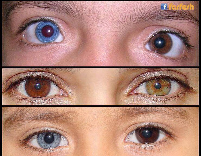 ���� ����� ������ ����� ������� ������� ���� ��� �� ���� ��������� ���� ��� ������ (Heterochromia)