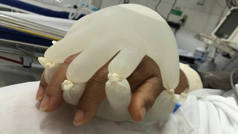 ممرضة برازيلية تبتكر يدا مزيفة تمد مرضى كورونا المعزولين بالدفء!