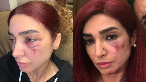 إصابة مروعة لروجينا أثناء تصوير مسلسل (بنت السلطان)! وأول تعليق لها