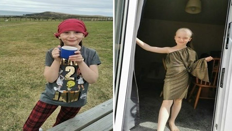 التوتر يصيب فتاة بالصلع