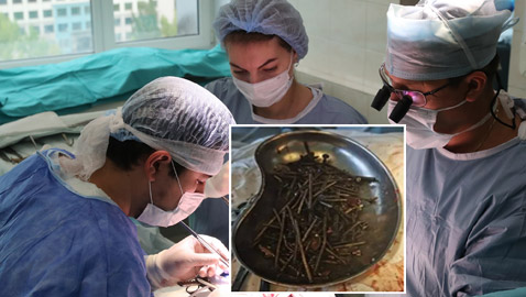 أغرب عملية جراحية.. أطباء يعثرون على مسامير وبراغي في معدة مريض!