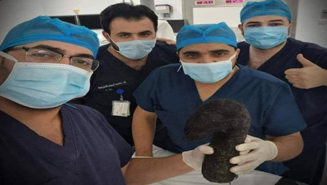 استخراج كتلة شعر ضخمة وزنها 6 كغم من بطن فتاة في الأردن! صور