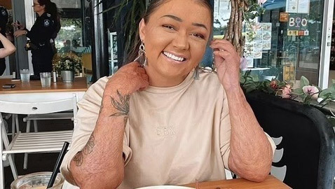 تتحول إلى عارضة أزياء رغم إصابتها بحروق