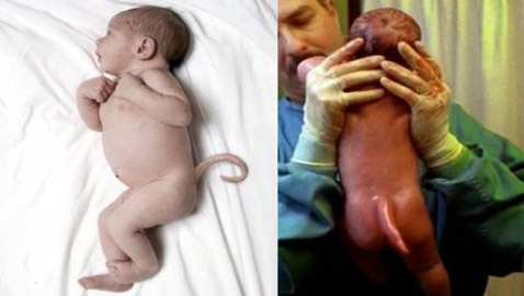 حالة نادرة.. ولادة طفل بذيل بشرى 12 سم فى البرازيل