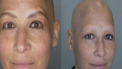 تفقد شعرها بالكامل بسبب حالة نادرة