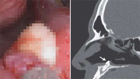 بعد سنوات من صعوبة التنفس.. مريض يكتشف نمو سن داخل أنفه! صور