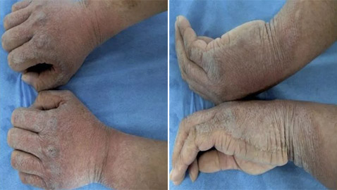 بقع سميكة ومنتفخة.. شاب يصاب بمرض جلدي نادر كلما لمس الماء!