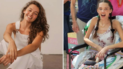 قصة عارضة الأزياء التي فقدت ساقيها بعد إصابتها بفيروس كورونا