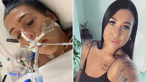 نهاية مأساوية لعملية تجميل.. أسترالية تواجه الموت بعد إصابتها بعدوى قاتلة