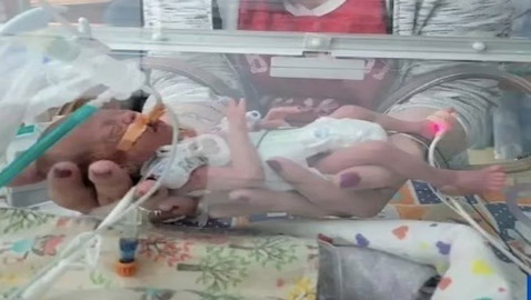 نجاة طفلة من الموت ولدت بمريء منفصل بفضل جراحة رائدة