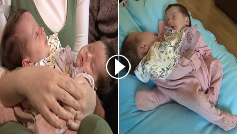 فيديو وصور توأم ملتصق.. معجزة وحالة نادرة! ماذا يقول الوالدان وهل ستتم عملية الفصل؟