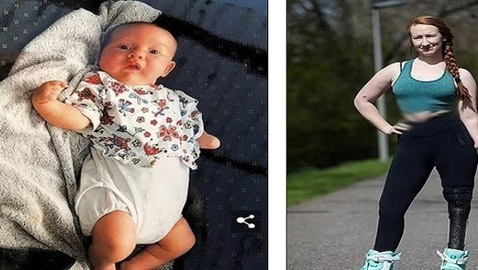 تتحدى إعاقتها وتتعلم التزلج ورفع الأثقال باستخدام الأطراف الاصطناعية