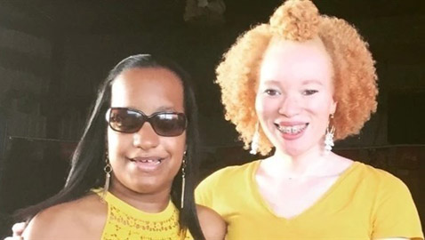 تتحدى حالة نادرة تسببت بـ 100 كسر في جسمها