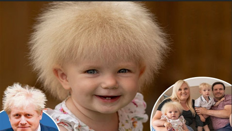 متلازمة نادرة.. رضيعة تثير الجدل بشدة شبهها لبوريس جونسون... شاهد