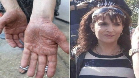 اعتقدت أن حكة يديها من منتجات التنظيف.. فاكتشف أنها مصابة بالسرطان