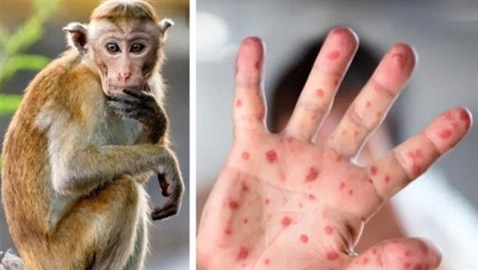 نيويورك تعلن حالة الطوارئ بسبب جدري القردة