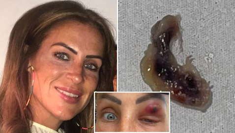 كأفلام الخيال العلمي: طفيلي يخرج من عين سيدة بعد تسلله داخل جسدها!