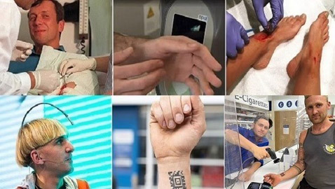 أغرب حالات لأشخاص زرعوا أجهزة إلكترونية في أجسامهم