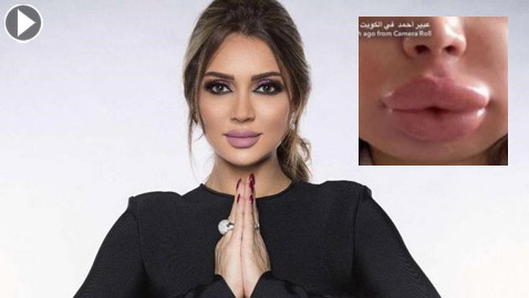 فيديو صادم وتحذير: فنانة مصرية تكشف كيف تشوه وجهها بعد عملية تجميل! 