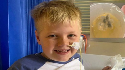 صور: إخراج وردة بلاستيكية من حنجرة طفل بعد 5 سنوات من المعاناة