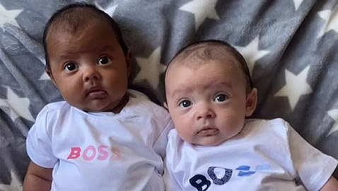 في حالة من مليون.. توأم بريطاني بلوني بشرتين مختلفين تماما