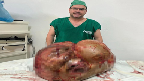 فريق طبي يستأصل ورما وزنه 45 كغم من جسد امرأة بالبرازيل! صور