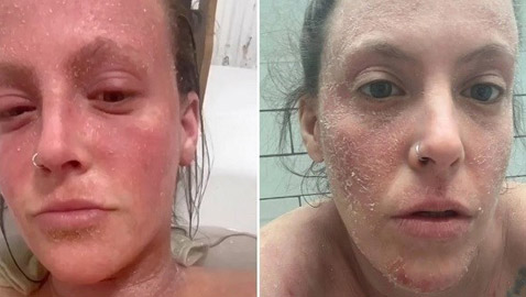 تمتنع عن مغادرة المنزل بسبب كريم للأكزيما !