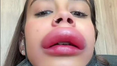 حقنة بوتوكس تشوه وجه فتاة بشكل مخيف