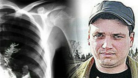 طولها 5 سم.. قصة رجل عثر الأطباء على شجرة في رئتيه! صور
