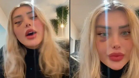 تنفجر مؤخرة رأسها بسبب ضغط الهواء في الطائرة