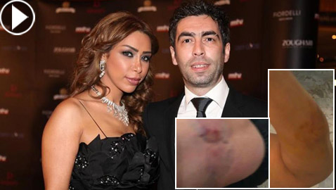 صور صادمة: طليقة سعيد الماروق تفضحه: أكل لحمي بأسنانه وضربني بقسوة وأسال دمي!