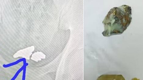 يبتلع كمية كبيرة من الذهب محاولاً تهريبها .. والنتيجة؟