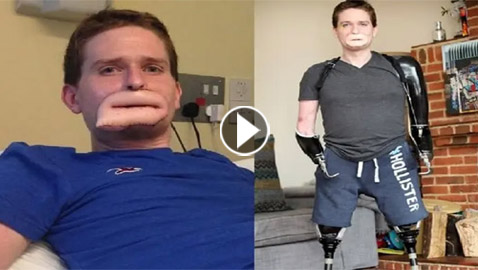 بكتيريا مرعبة فتكت بأطفال وبترت أطراف رجل وجعلته بفم غريب!