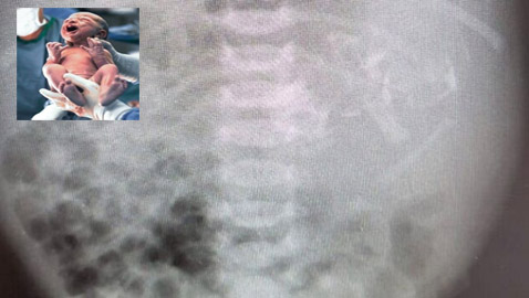 طفلة تولد بحالة نادرة بعد العثور على توأمها داخل معدتها