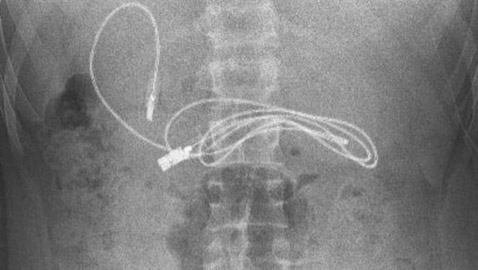 أطباء يستخرجون سلك شاحن هاتف...من معدة مراهق