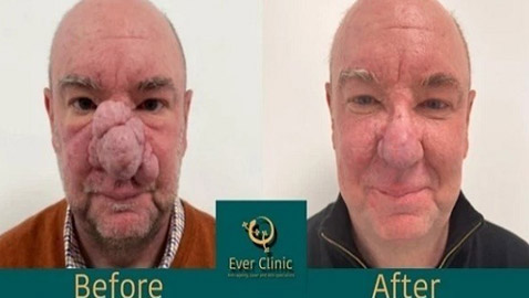 تخليص اسكتلندي من أنفه الضخم بالليزر