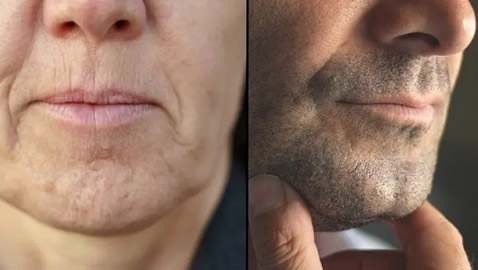 خيبة أمل... بعد معرفة سبب تشكل غمازات الذقن