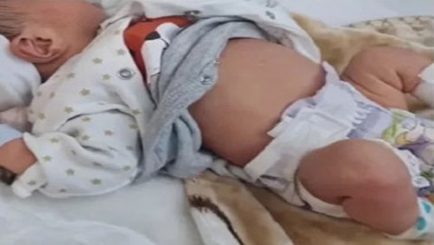 حالة نادرة جدا.. ولادة طفل يحمل توأمه في بطنه!