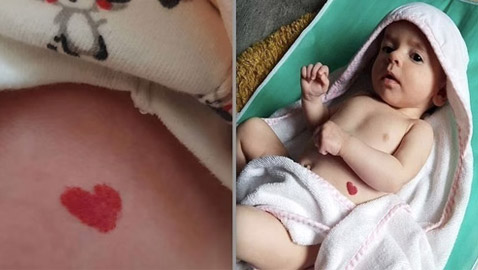 في عيد الحب.. طفلة بريطانية تولد بوحمة حمراء على شكل قلب